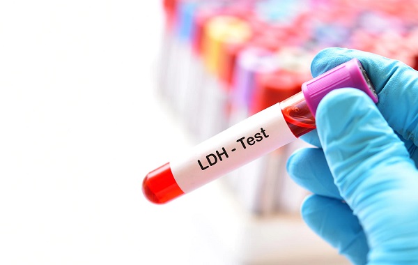 Xét nghiệm đo hoạt độ LDH là gì? | PK BV Đại học Y Dược 1