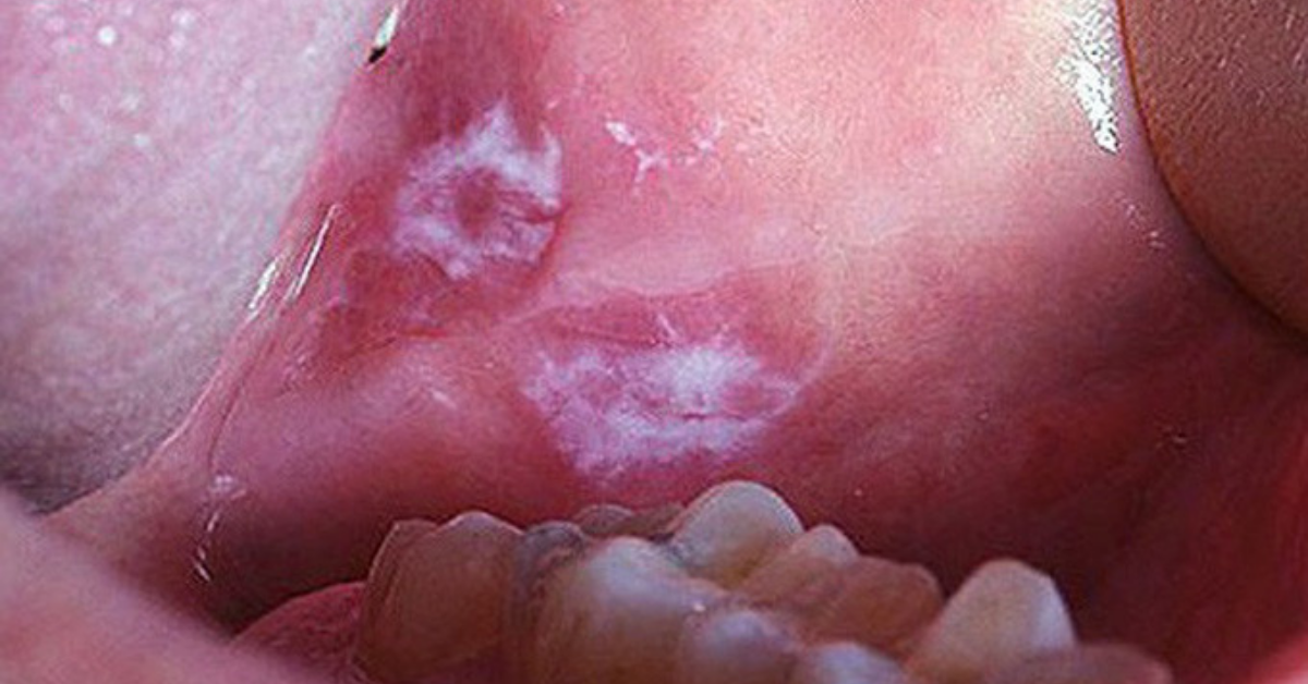 Lichen phẳng là gì? Triệu chứng, nguyên nhân và cách điều trị