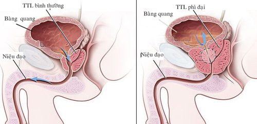 Luts (Lower Urinary Tract Symptoms) – Triệu chứng đường tiểu dưới và Những điều cần biết