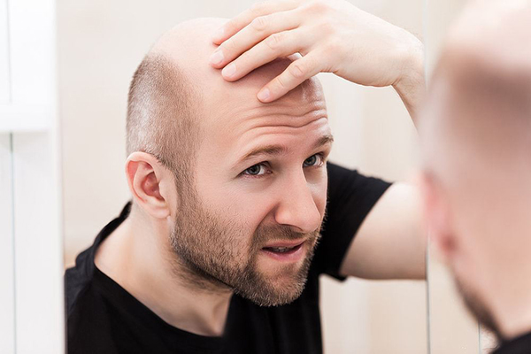 Ysl gây rụng tóc ở nam giới