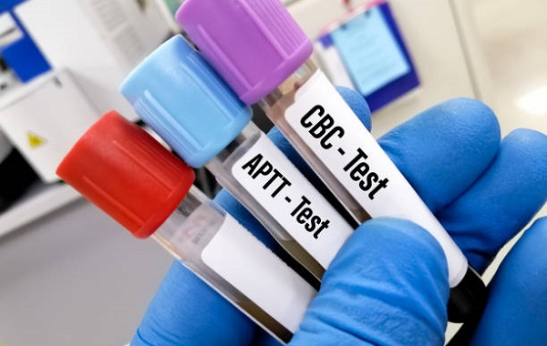 Xét nghiệm thromboplastin một phần hoạt hóa (aPTT)