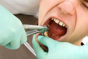 Nhổ răng tiếng anh là gì? Những câu giao tiếp nhổ răng bằng tiếng Anh trong nha khoa