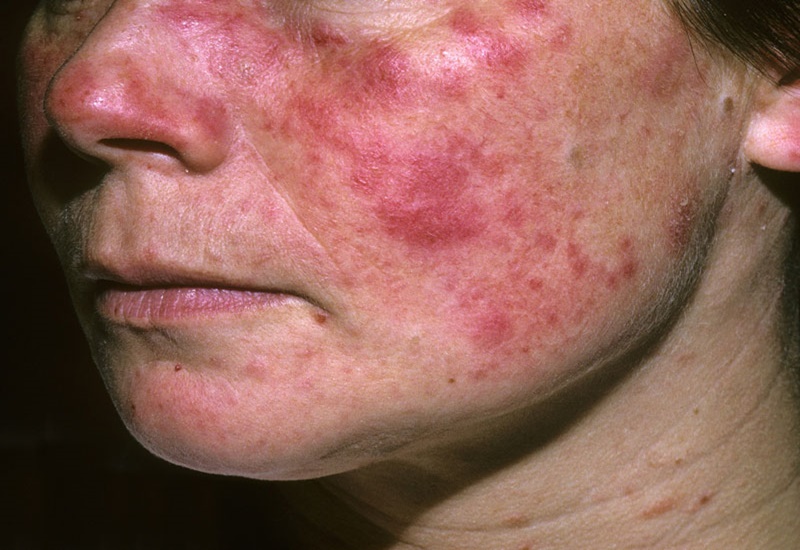 Lupus ban đỏ gây ra nhiều tổn thương trên da