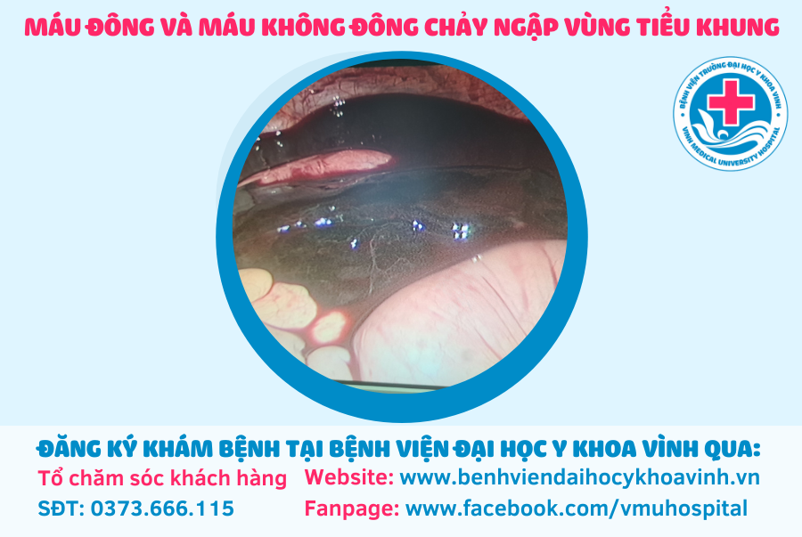 Phẫu thuật cấp cứu thành công cho BN người Lào bị xuất huyết ổ bụng do vỡ nang DeGraff